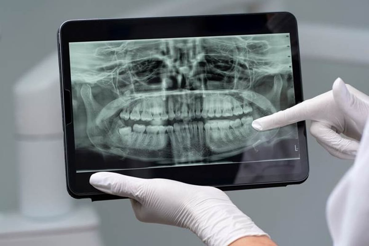 Dentes fracos: quais são as causas e como tratar?