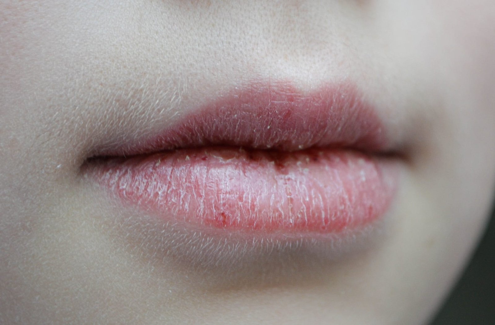 Entenda por que os lábios racham no inverno e como prevenir o ressecamento