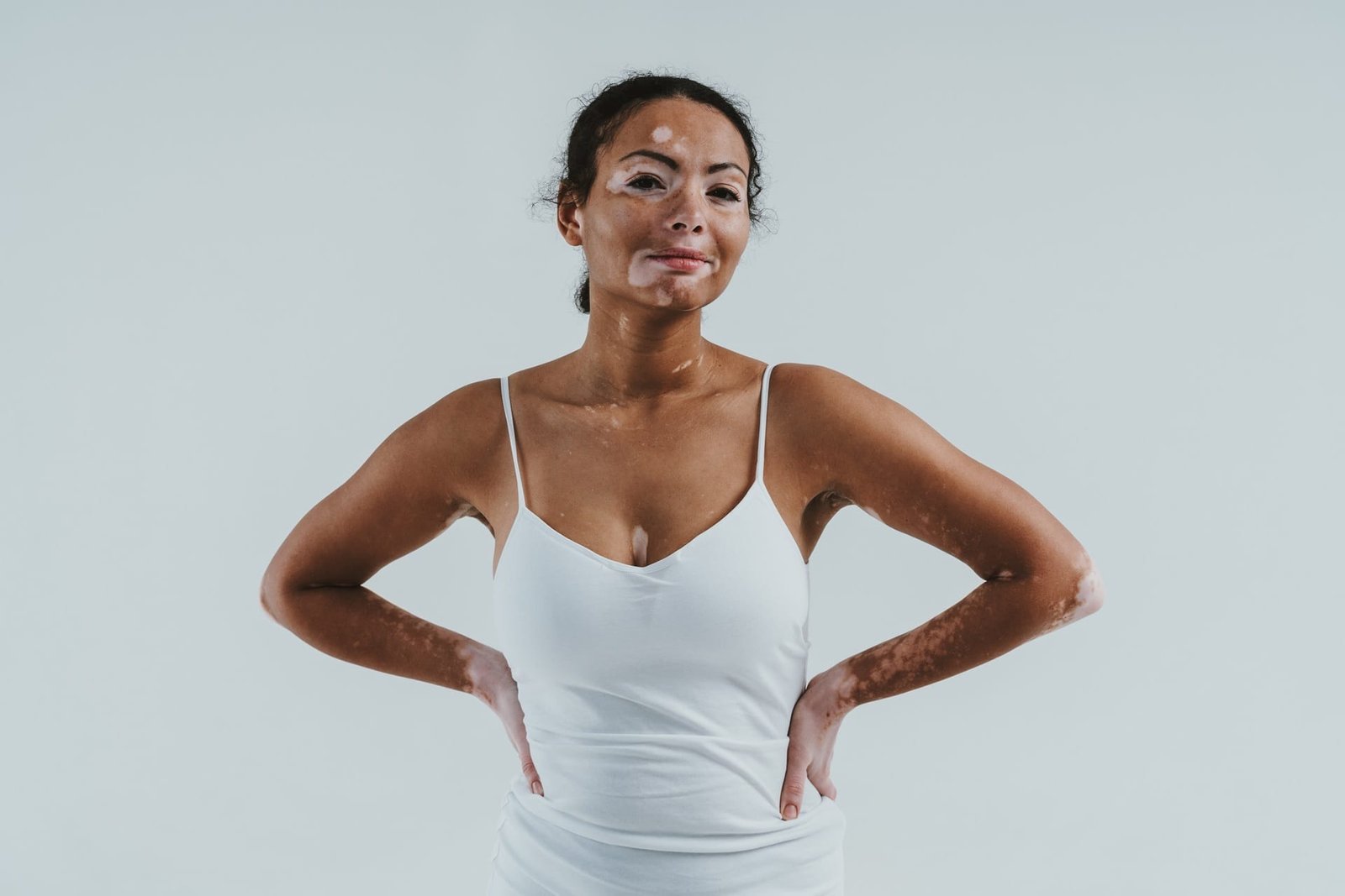 Campanha cobra políticas públicas para o vitiligo