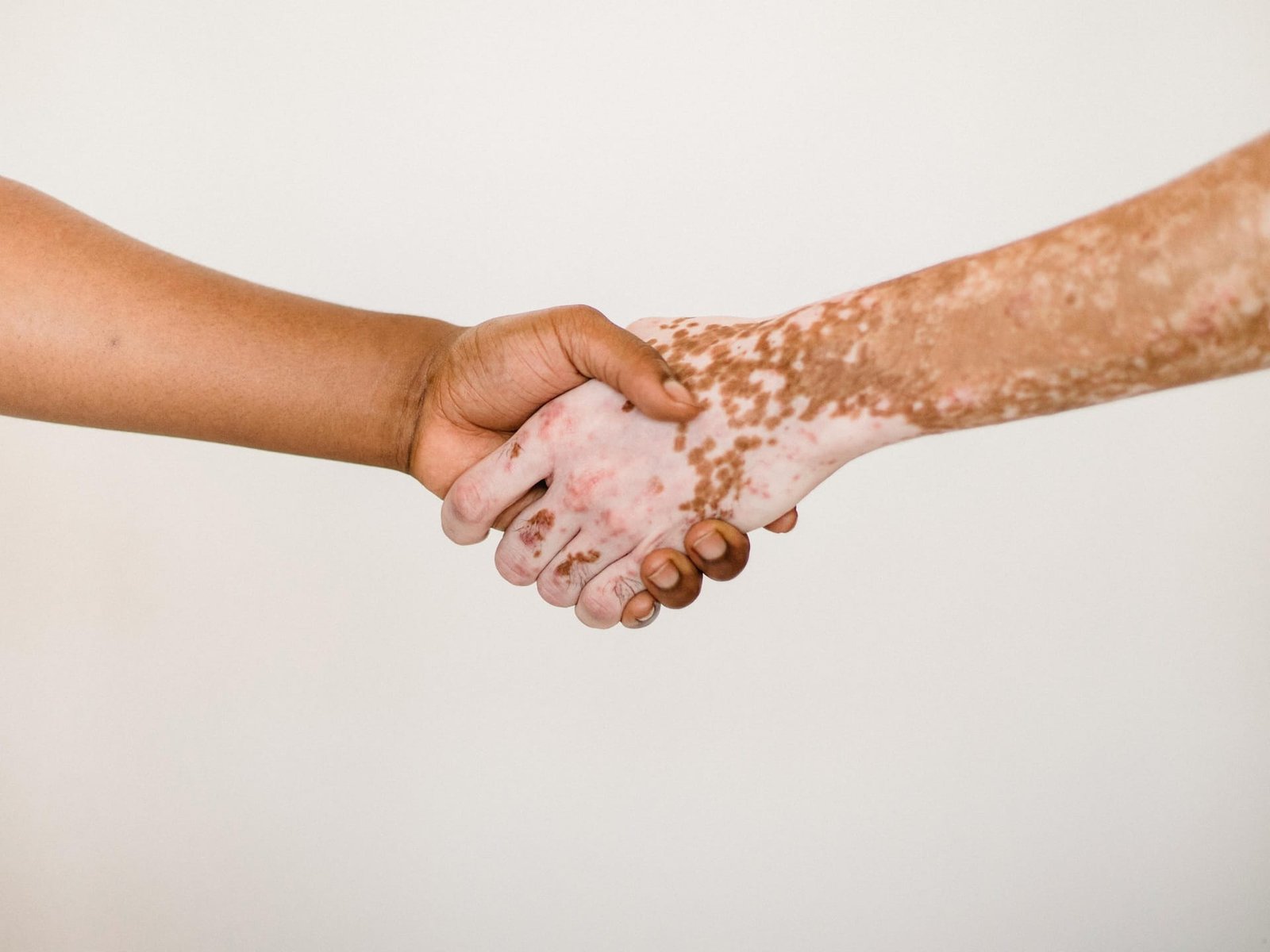 Psoríase ganha novas opções de tratamento e esperança de controle duradouro