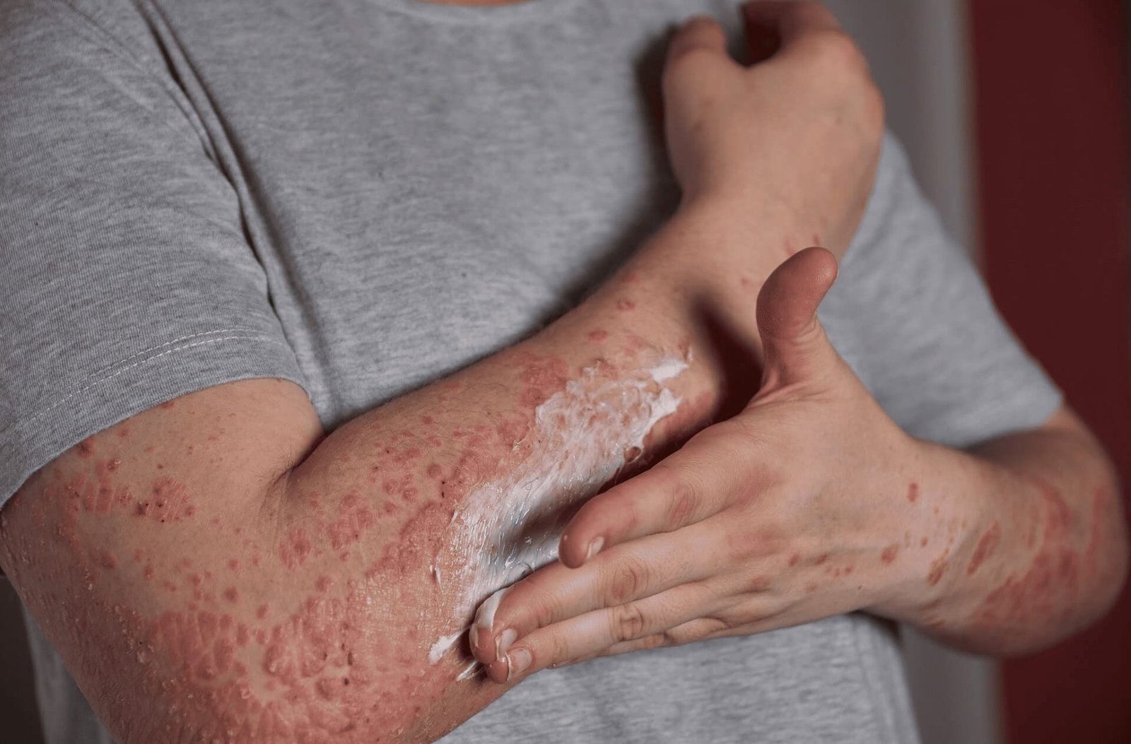 Encontro na Assembleia Legislativa do RS cobra implementação de política para doenças crônicas de pele